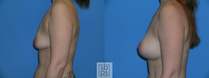 Before & After Breast Augmentation Case 88 View #4 View in Torrance, CA