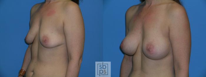 Before & After Breast Augmentation Case 88 View #5 View in Torrance, CA