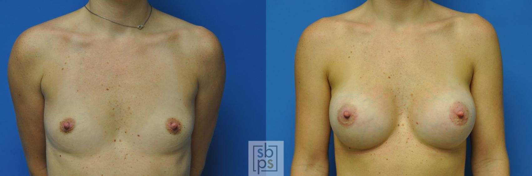 Before & After Breast Augmentation Case 91 View #1 View in Torrance, CA