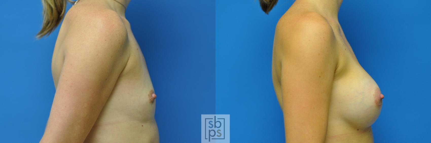 Before & After Breast Augmentation Case 91 View #2 View in Torrance & Los Angeles, CA, CA