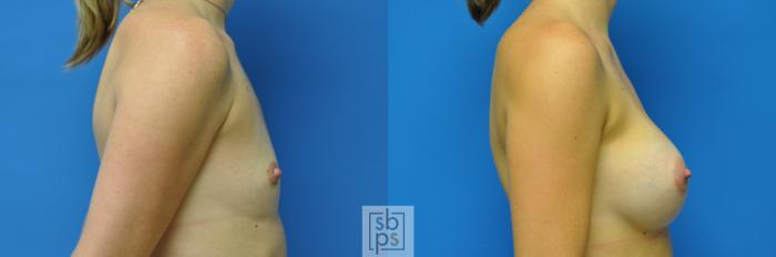 Before & After Breast Augmentation Case 91 View #2 View in Torrance, CA