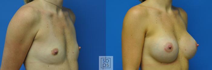 Before & After Breast Augmentation Case 91 View #3 View in Torrance, CA