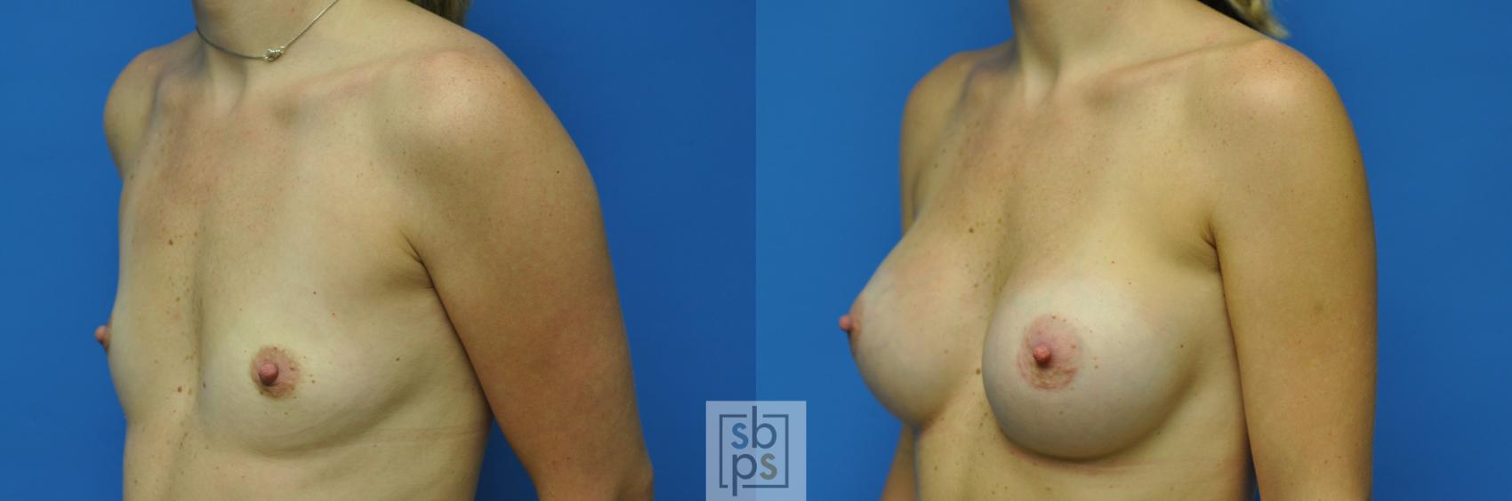 Before & After Breast Augmentation Case 91 View #5 View in Torrance & Los Angeles, CA, CA
