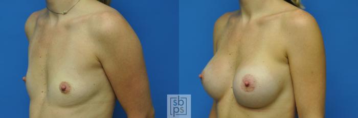 Before & After Breast Augmentation Case 91 View #5 View in Torrance, CA