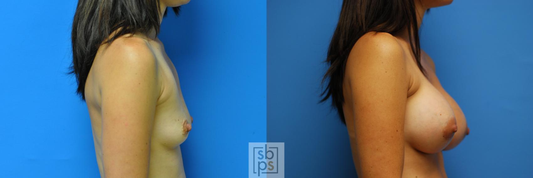 Before & After Breast Augmentation Case 94 View #1 View in Torrance, CA
