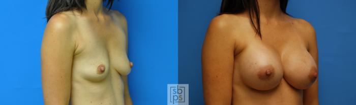 Before & After Breast Augmentation Case 94 View #2 View in Torrance, CA