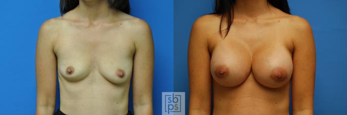 Before & After Breast Augmentation Case 94 View #3 View in Torrance, CA
