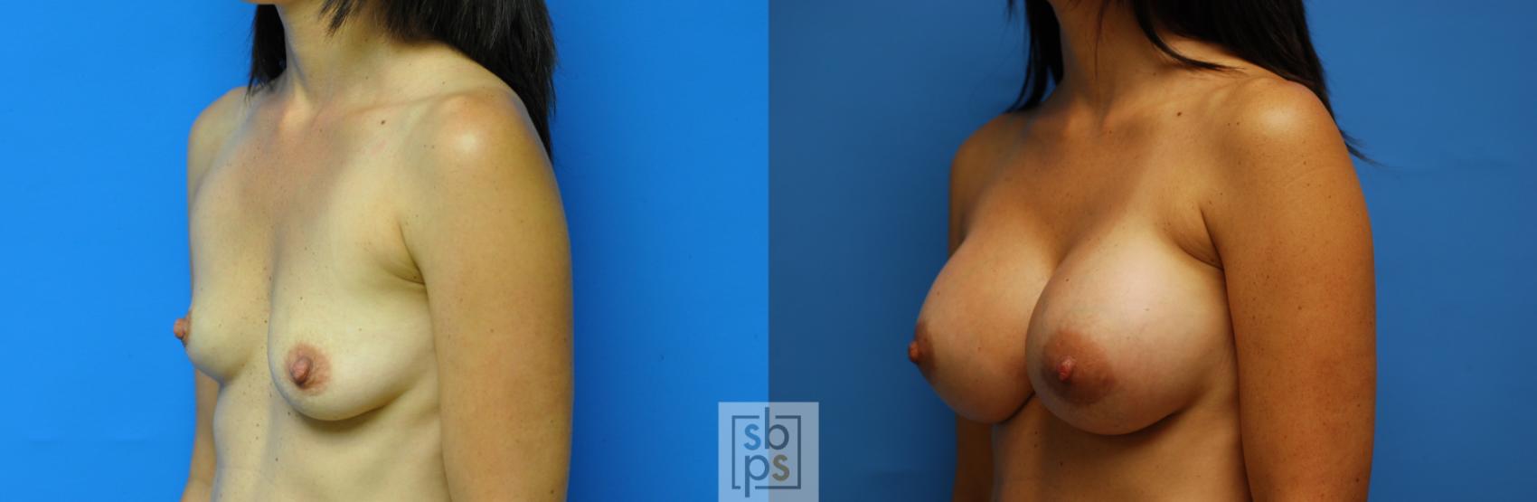 Before & After Breast Augmentation Case 94 View #4 View in Torrance & Los Angeles, CA, CA