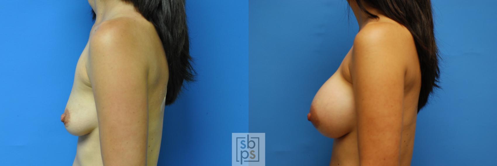 Before & After Breast Augmentation Case 94 View #5 View in Torrance & Los Angeles, CA, CA