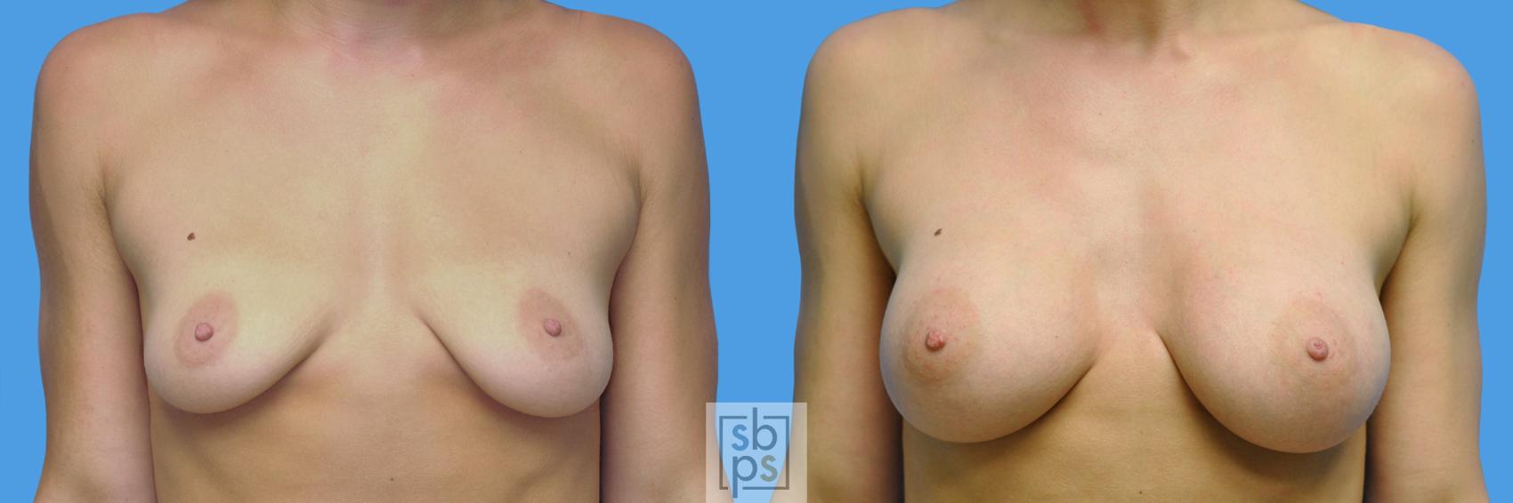 Before & After Breast Augmentation Case 97 View #1 View in Torrance, CA