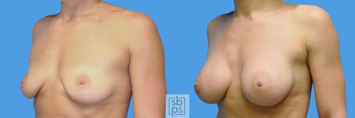 Before & After Breast Augmentation Case 97 View #2 View in Torrance, CA