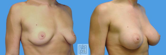 Before & After Breast Augmentation Case 97 View #3 View in Torrance, CA