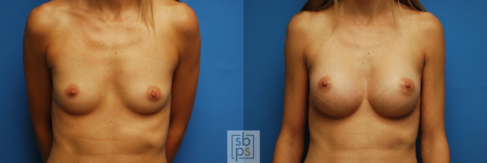 Before & After Breast Augmentation Case 99 View #1 View in Torrance, CA