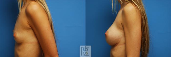 Before & After Breast Augmentation Case 99 View #2 View in Torrance, CA
