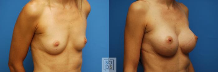 Before & After Breast Augmentation Case 99 View #4 View in Torrance, CA