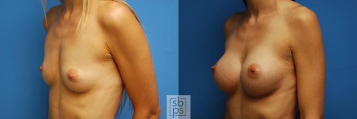 Before & After Breast Augmentation Case 99 View #5 View in Torrance, CA