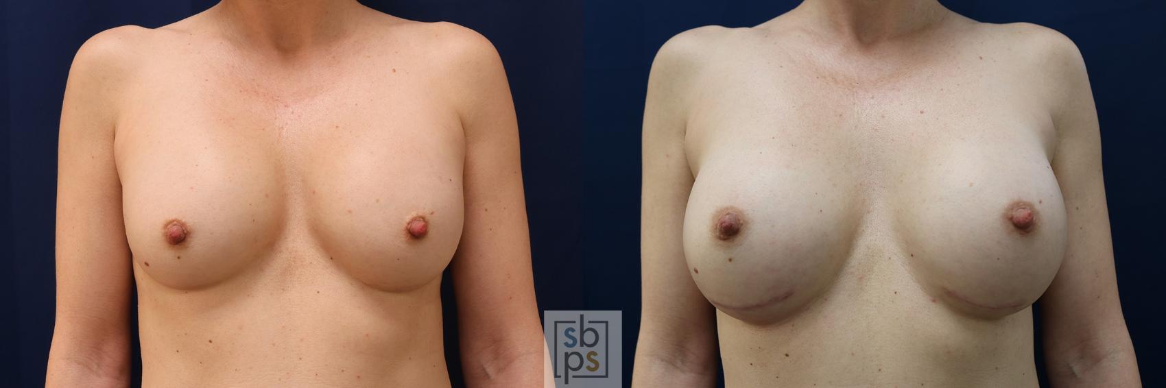 Before & After Breast Augmentation Revision Case 572 Front View in Los Angeles & Torrance, CA, CA