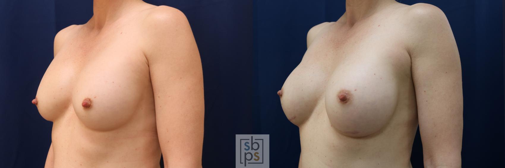Before & After Breast Augmentation Case 572 Left Oblique View in Torrance & Los Angeles, CA, CA