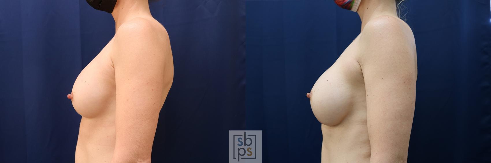 Before & After Breast Augmentation Case 572 Left Side View in Torrance & Los Angeles, CA, CA