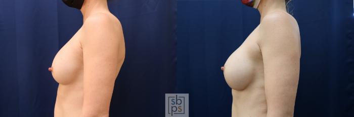 Before & After Breast Augmentation Revision Case 572 Left Side View in Los Angeles & Torrance, CA, CA