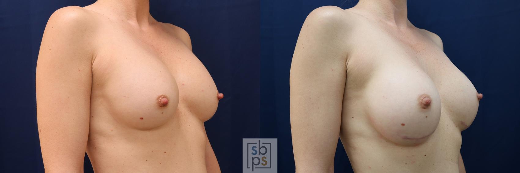 Before & After Breast Augmentation Case 572 Right Oblique View in Torrance & Los Angeles, CA, CA