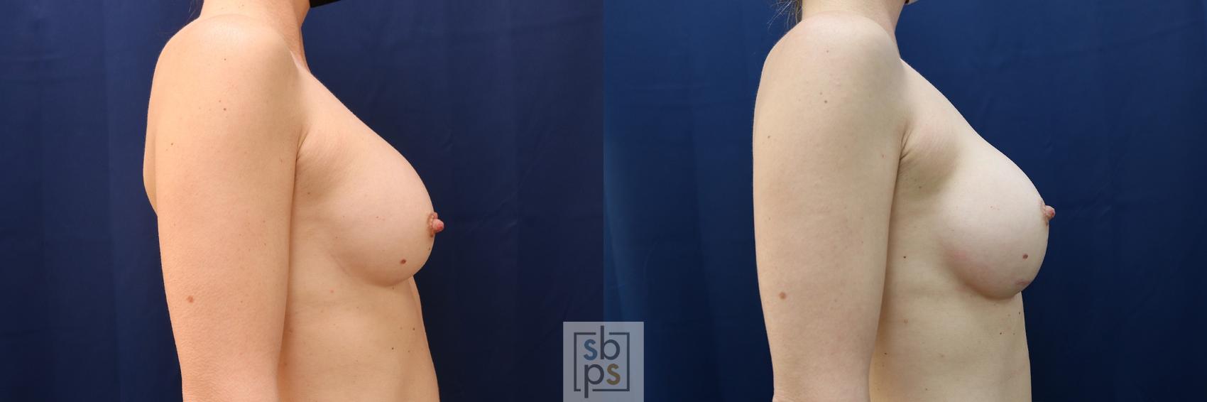 Before & After Breast Augmentation Case 572 Right Side View in Torrance & Los Angeles, CA, CA