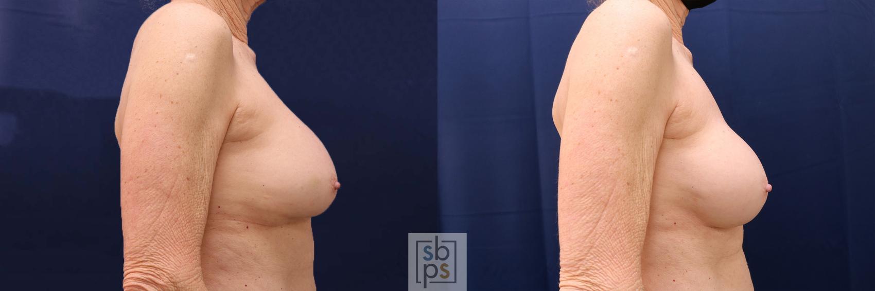 Before & After Breast Augmentation Revision Case 584 Left Side View in Torrance & Los Angeles, CA, CA