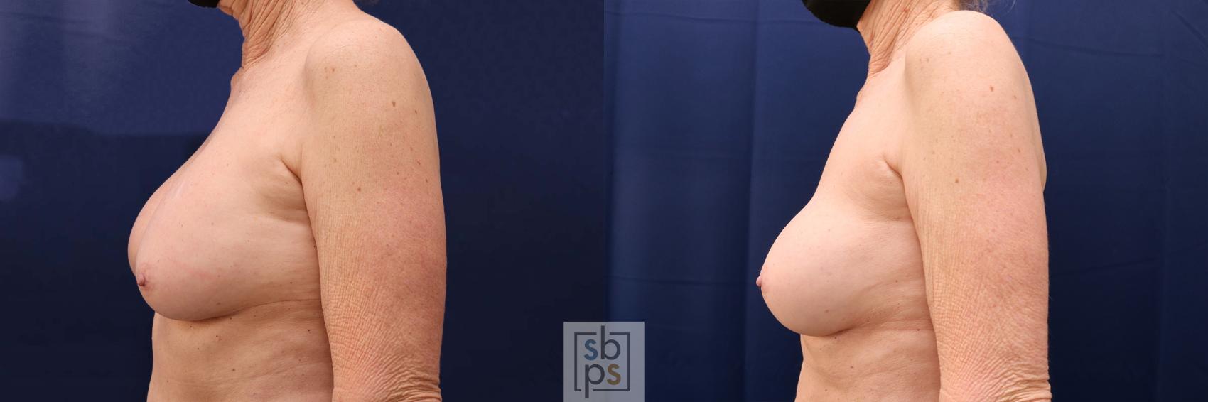 Before & After Breast Augmentation Revision Case 584 Right Side View in Torrance & Los Angeles, CA, CA