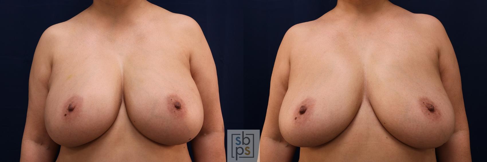 Before & After Breast Augmentation Case 594 Front View in Torrance, CA