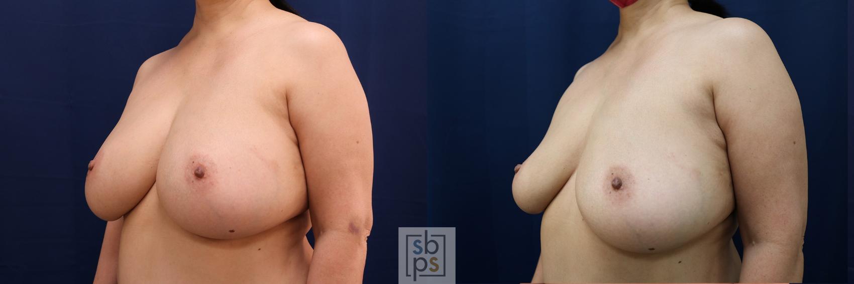 Before & After Breast Augmentation Case 594 Left Oblique View in Torrance & Los Angeles, CA, CA