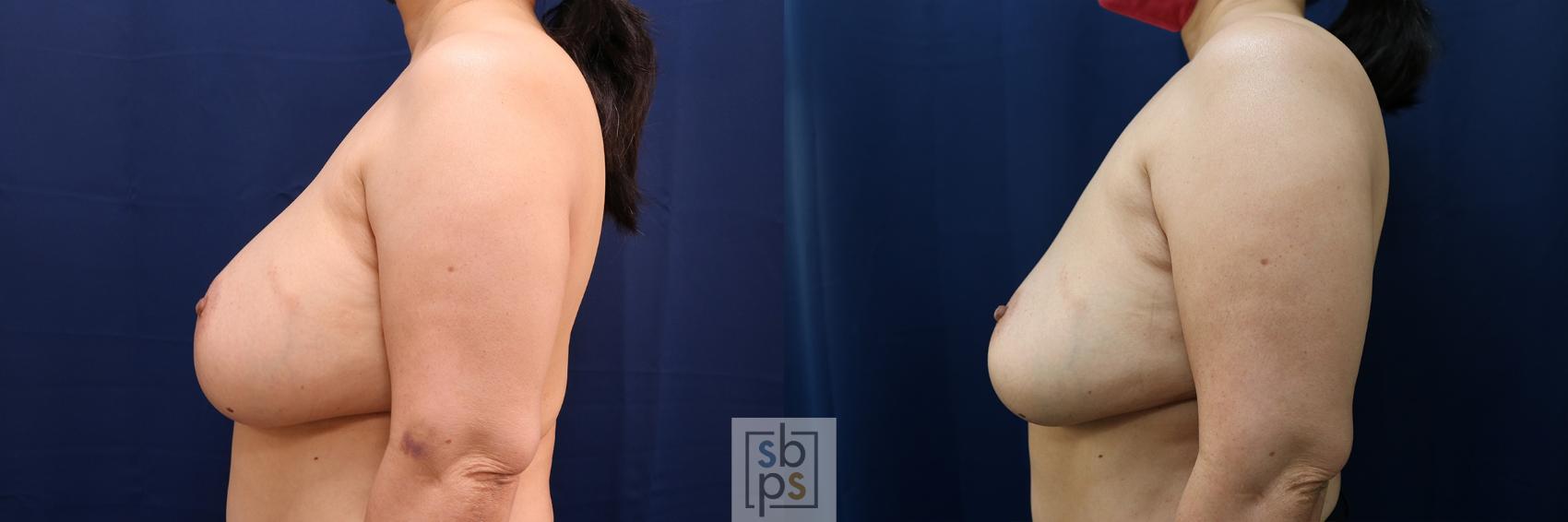 Before & After Breast Augmentation Case 594 Left Side View in Torrance & Los Angeles, CA, CA