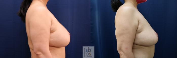 Before & After Breast Augmentation Case 594 Right Side View in Torrance, CA