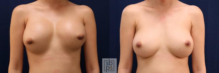 Before & After Breast Augmentation Revision Case 656 Front View in Torrance, CA
