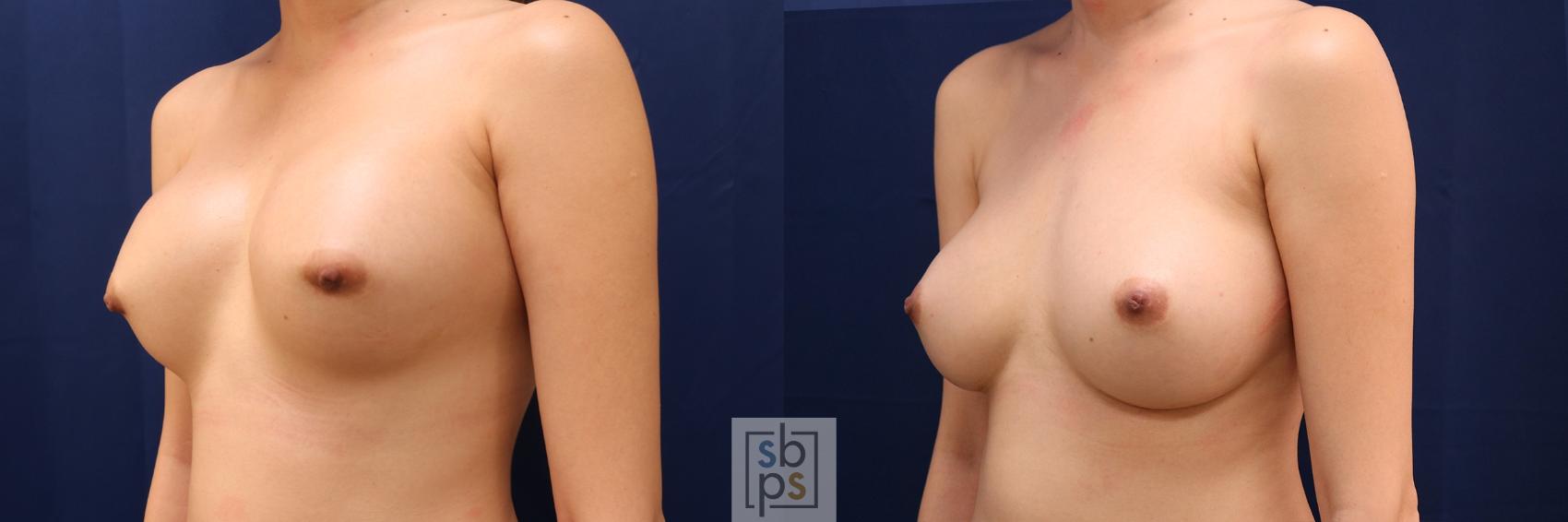 Before & After Breast Augmentation Revision Case 656 Left Oblique View in Torrance & Los Angeles, CA, CA