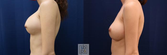 Before & After Breast Augmentation Revision Case 656 Left Side View in Torrance, CA