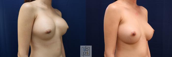 Before & After Breast Augmentation Revision Case 656 Right Oblique View in Torrance, CA