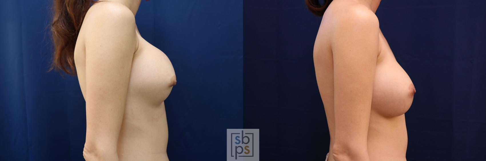 Before & After Breast Augmentation Revision Case 656 Right Side View in Torrance & Los Angeles, CA, CA