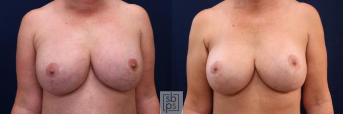 Before & After Corrective Breast Surgery Case 697 Front View in Los Angeles & Torrance, CA, CA