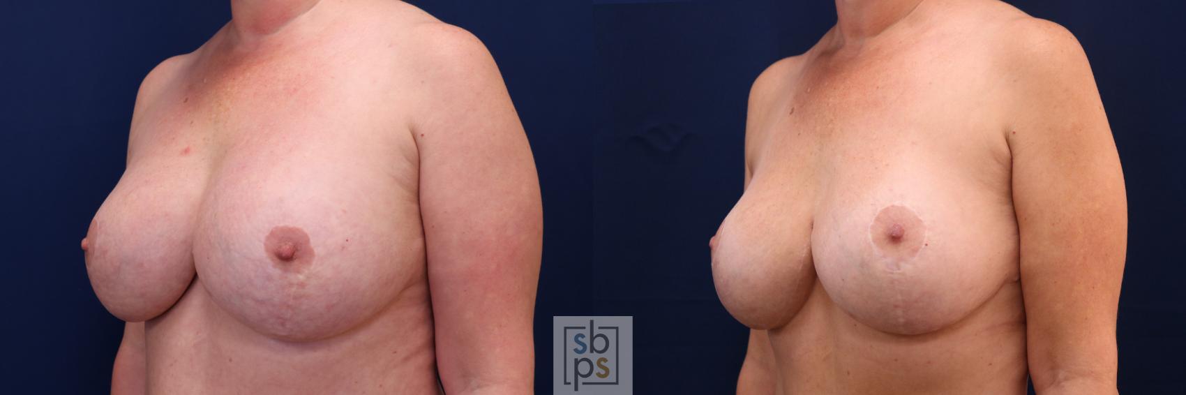 Before & After Breast Augmentation Revision Case 697 Left Oblique View in Torrance & Los Angeles, CA, CA