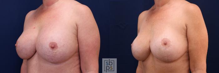 Before & After Corrective Breast Surgery Case 697 Left Oblique View in Los Angeles & Torrance, CA, CA