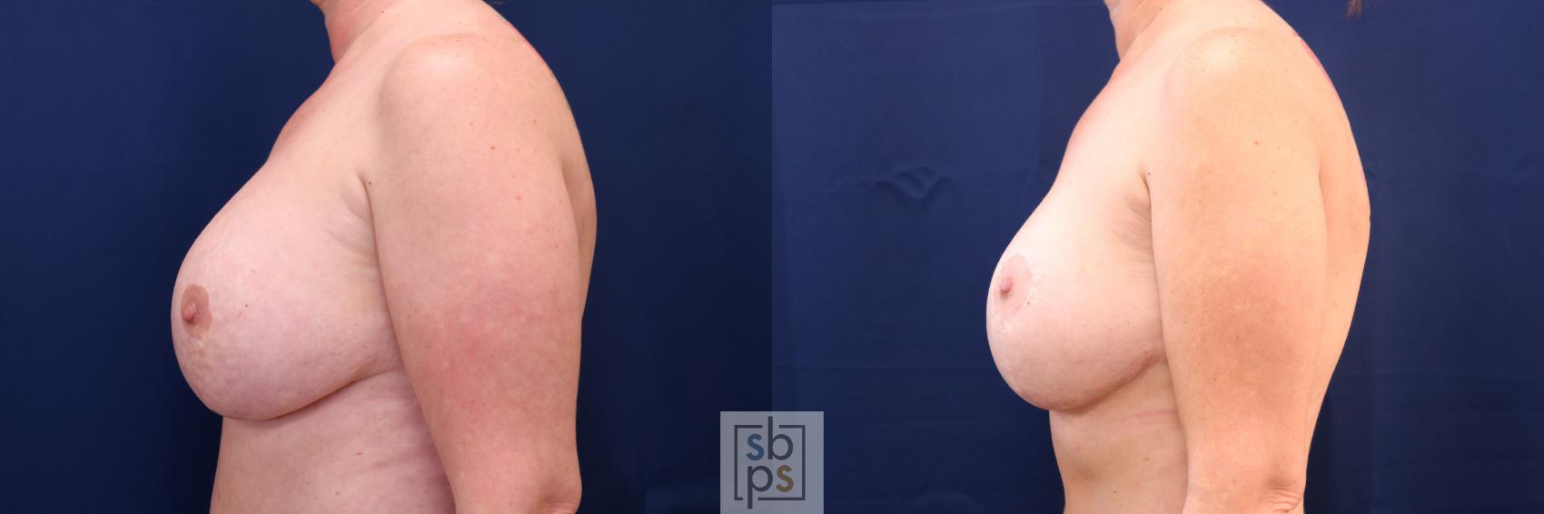 Before & After Breast Augmentation Revision Case 697 Left Side View in Torrance & Los Angeles, CA, CA