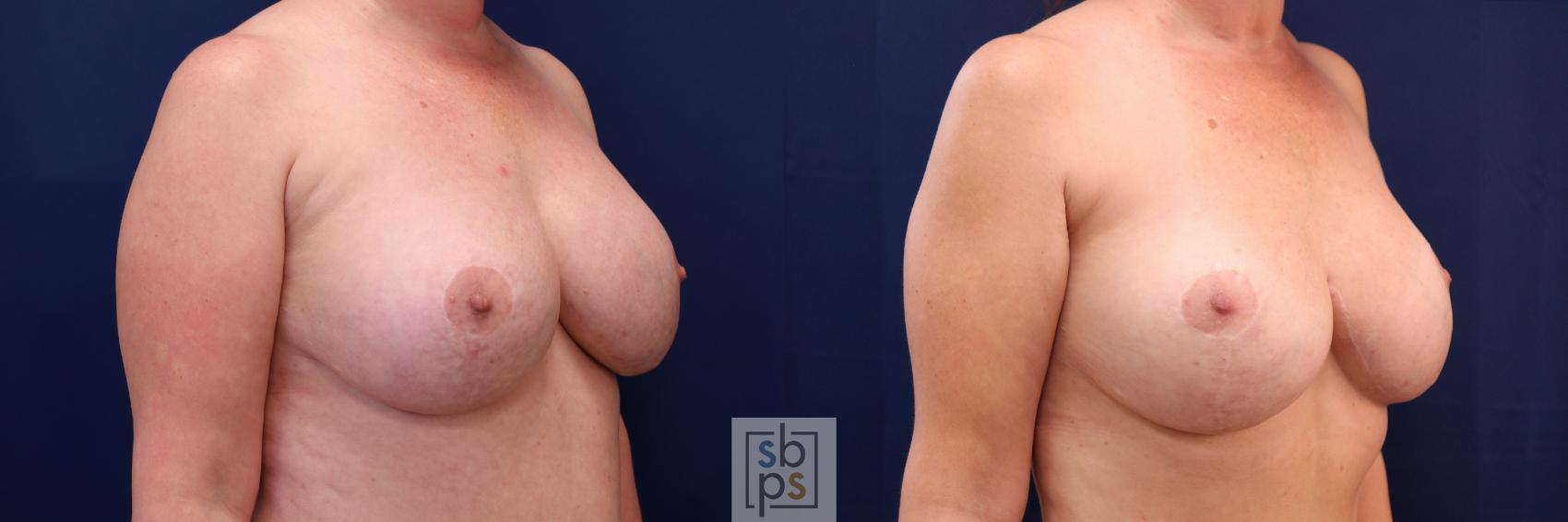 Before & After Breast Augmentation Revision Case 697 Right Oblique View in Torrance & Los Angeles, CA, CA