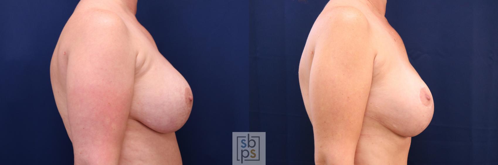 Before & After Breast Augmentation Revision Case 697 Right Side View in Torrance & Los Angeles, CA, CA