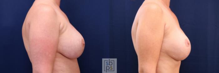 Before & After Corrective Breast Surgery Case 697 Right Side View in Los Angeles & Torrance, CA, CA