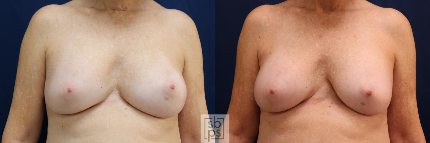 Before & After Breast Augmentation Revision Case 698 Front View in Los Angeles & Torrance, CA, CA