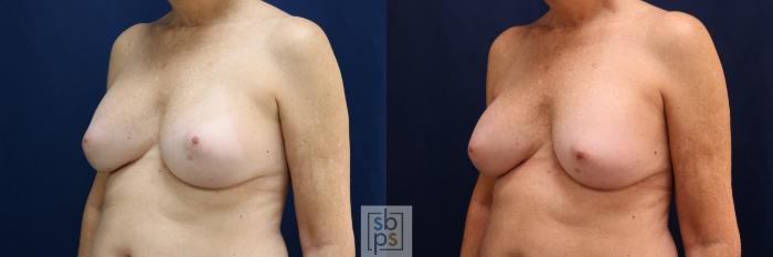 Before & After Breast Augmentation Revision Case 698 Left Oblique View in Los Angeles & Torrance, CA, CA