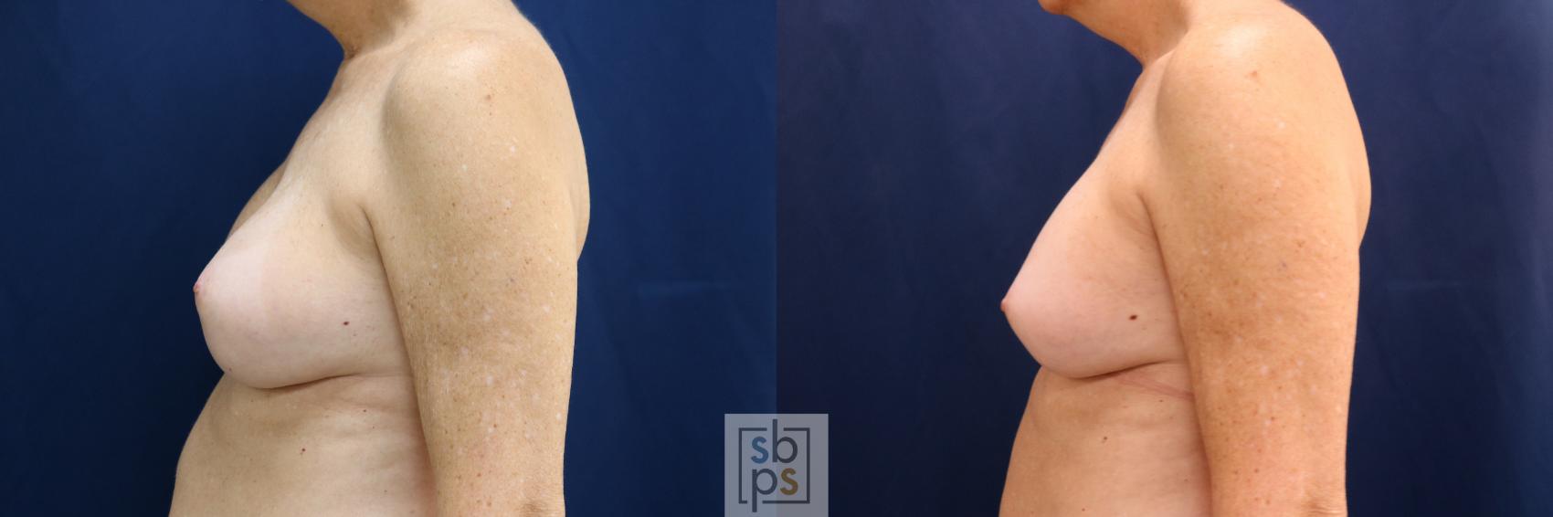 Before & After Breast Augmentation Revision Case 698 Left Side View in Torrance & Los Angeles, CA, CA