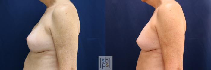 Before & After Breast Augmentation Revision Case 698 Left Side View in Los Angeles & Torrance, CA, CA