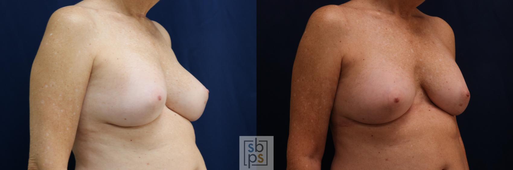 Before & After Breast Augmentation Revision Case 698 Right Oblique View in Torrance & Los Angeles, CA, CA