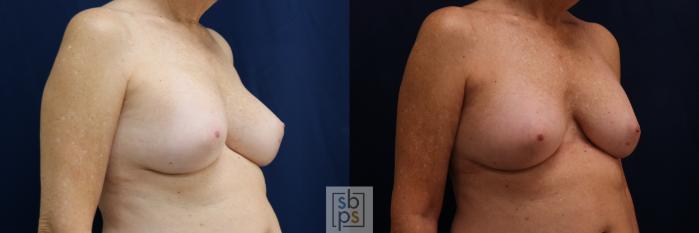 Before & After Breast Augmentation Revision Case 698 Right Oblique View in Los Angeles & Torrance, CA, CA